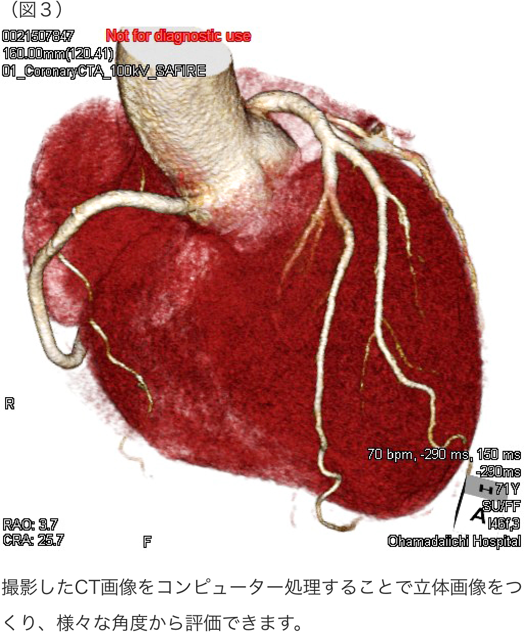 心臓 冠動脈模型 - その他