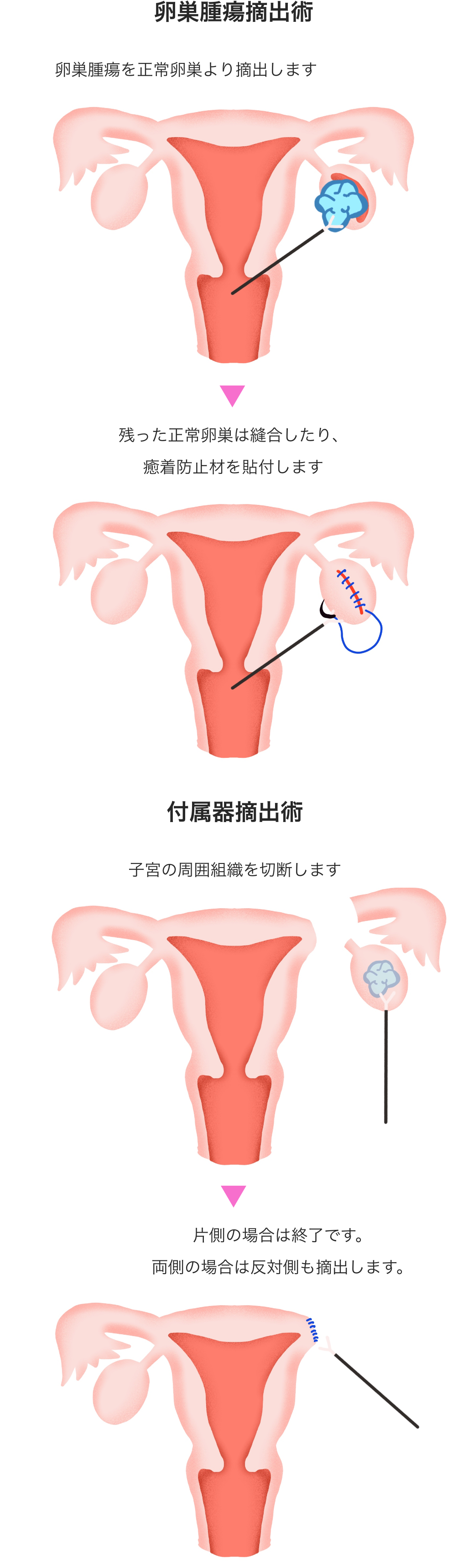 リスク 子宮 筋腫 手術